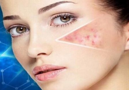 宜賓青春痘治療哪家醫(yī)院效果好？