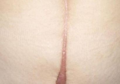 瀘州哪家醫(yī)院祛痘祛痘印好？全面解析瀘州專業(yè)祛痘醫(yī)院