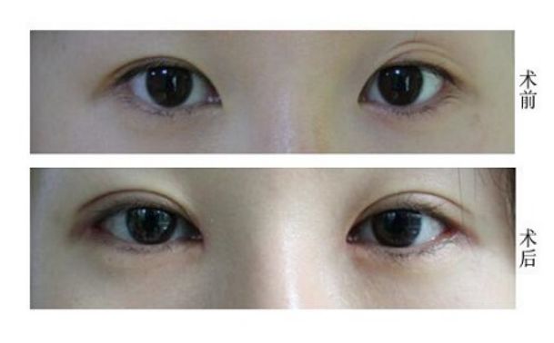 成都市假體隆鼻醫(yī)院哪家好？權(quán)威排名揭曉，專家點評詳解！