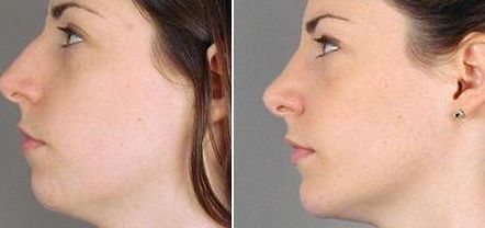 【2023邯鄲祛痘印醫(yī)院哪家好？專家推薦排行榜】