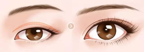 鄭州市比較好的雙眼皮整形醫(yī)生排名更新！2023年價格一覽表附錄！