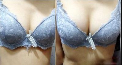 廣州哪家醫(yī)院的乳頭凹陷術(shù)效果好？