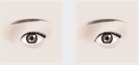 【吉林雙眼皮割的好，哪家醫(yī)院口碑最佳？】