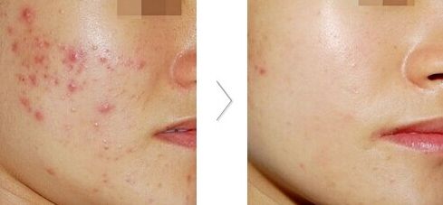 大連雙眼皮整形醫(yī)院哪家好？推薦大連哪家整形雙眼皮效果最佳