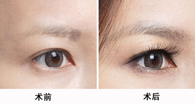 韓國醫(yī)生張柱允的顴骨磨骨技術(shù)整容潮流。