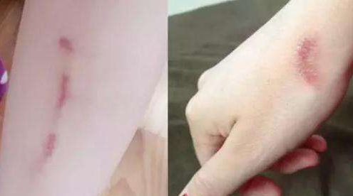 邵陽(yáng)去痘去斑哪家醫(yī)院好？選擇正規(guī)醫(yī)療機(jī)構(gòu)，解決邵陽(yáng)去痘去斑問題