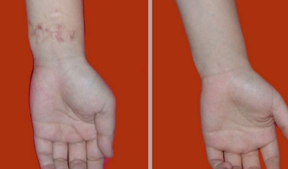 長沙激光祛痘哪家醫(yī)院好？專業(yè)醫(yī)院推薦及治療經(jīng)驗(yàn)分享