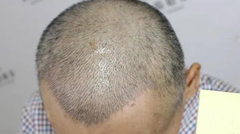 北京哪位醫(yī)生在拉皮手術(shù)方面有口碑？