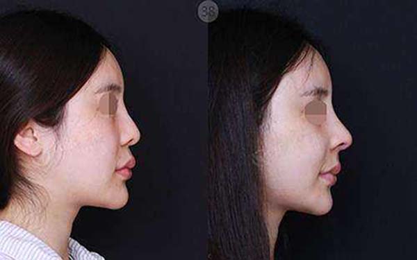 王麗妮手術(shù)案例：雙眼皮成真的秘密揭曉