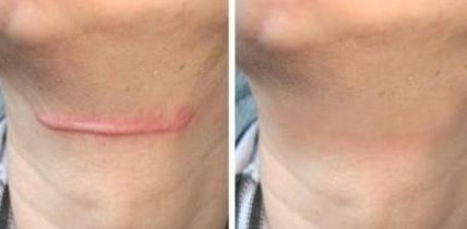 廣州哪家醫(yī)院植皮術(shù)效果好、專業(yè)的醫(yī)院推薦