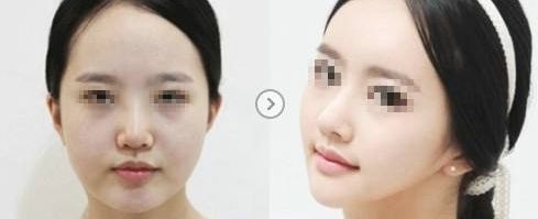 溫州哪家醫(yī)院祛除疤痕效果最佳，專家推薦！