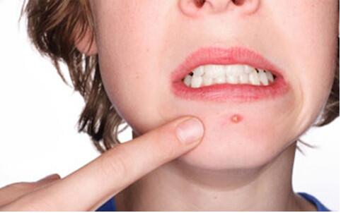 華中地區(qū)整形美容醫(yī)院張婷醫(yī)師的胎記祛除技巧跨越行業(yè)高度，備受贊譽(yù)！