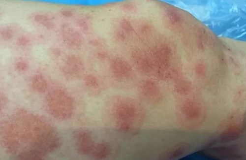 劉春軍豐胸經(jīng)驗(yàn)分享！北京八大處整形外科醫(yī)生解析！