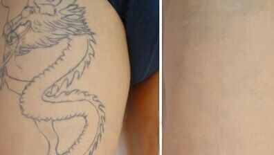 南京哪家醫(yī)院做面部提升效果最好？