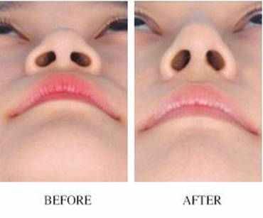 2023鄭州自體脂肪豐耳垂權(quán)威醫(yī)生排名前10位(陳鄉(xiāng)南、李永勝、徐海坤全網(wǎng)都在安利)