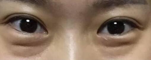 武漢鄭舉衛(wèi)在伊美馨醫(yī)院執(zhí)行乳房縮小手術(shù)效果如何？