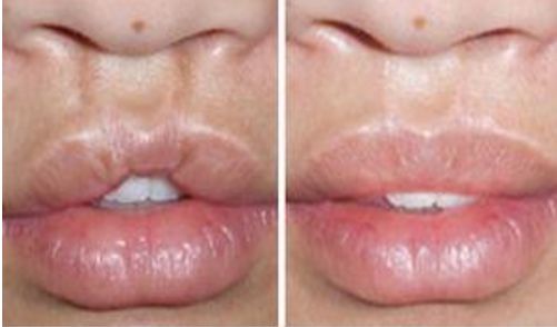 鞍山哪家醫(yī)院做手術除皺好