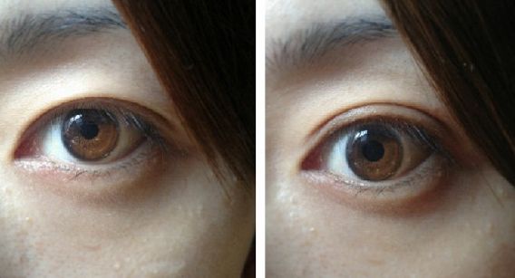 北京開眼角好的醫(yī)院有哪些？