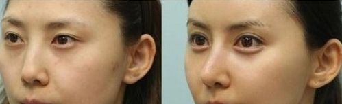 探尋上海玻尿酸隆鼻哪家好？選擇最優(yōu)質(zhì)的上海玻尿酸隆鼻機(jī)構(gòu)