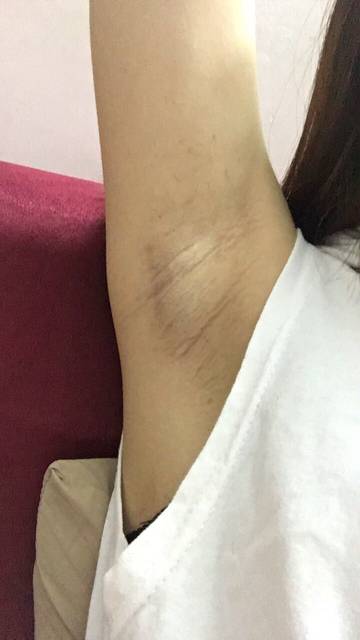 劉永生：醫(yī)生簡介及激光祛斑果圖介紹