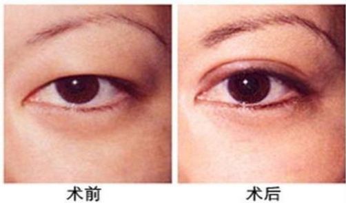 杭州做激光眼科手術(shù)哪家醫(yī)院好，專家推薦