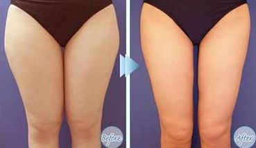 上海光澤醫(yī)院熱瑪吉效果如何？價格是多少？搭配醫(yī)生介紹一起了解