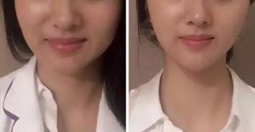 杭州激光祛斑好嗎？哪家激光祛斑的效果好？