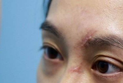 成都哪家醫(yī)院的脂肪填充臉效果好且安全？