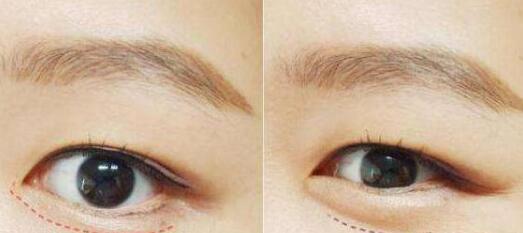 增美天使沈正宇教你打造完美鼻梁！深度揭秘示范案例，秀出新顏！