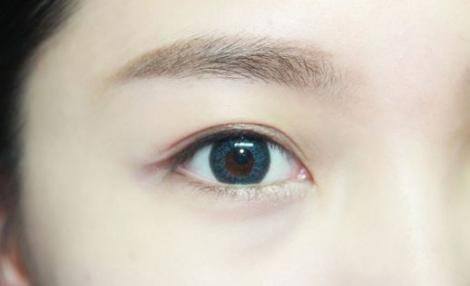 西安眼周玻尿酸除皺整形醫(yī)院口碑排行