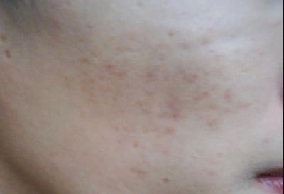 寧波祛疤哪家醫(yī)院哪里好？專家告訴你最佳選擇！