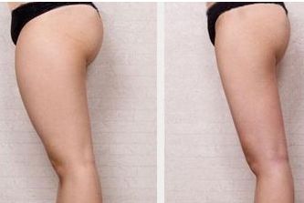 佛山哪家醫(yī)院治痘坑痘印效果好？推薦一家靠譜的醫(yī)院！