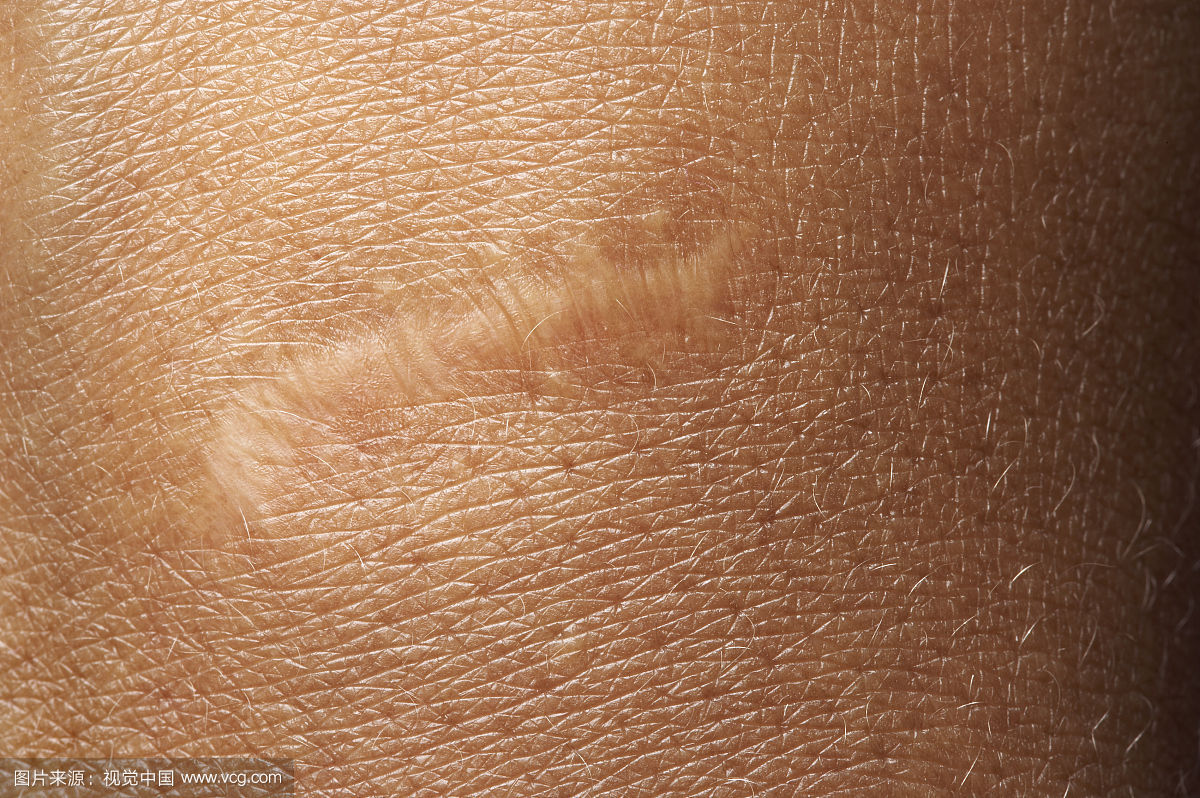 2023南昌疤痕性禿發(fā)口碑榜前10名的專家(李超、任鎮(zhèn)雄、李丹醫(yī)生技術(shù)點(diǎn)評(píng)好不好~)