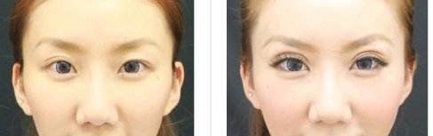 株洲哪家醫(yī)院做雙眼皮好？選擇醫(yī)院要注意這幾個(gè)關(guān)鍵點(diǎn)！