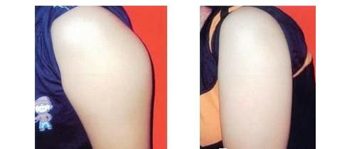 福州格萊美植發(fā)治療良效如何？黃興勇醫(yī)生發(fā)際線安全種植真的有效嗎？