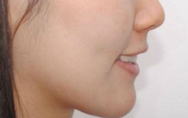 成都藝星周順波與陳遠(yuǎn)坤鼻子整形實(shí)力對(duì)決！術(shù)前比較，看誰(shuí)更擅長(zhǎng)鼻子！