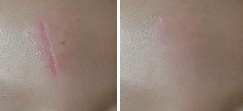 鄭州哪家醫(yī)院激光做的好？找尋專業(yè)！領(lǐng)先的鄭州醫(yī)院激光治療推薦