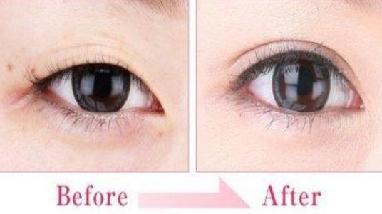 蘇州雙眼皮哪家做的好？專業(yè)攻略與醫(yī)師推薦