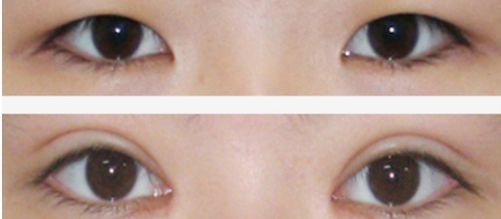 上海祛痘坑的醫(yī)院哪家好？讓你遠離痘痘困擾的專業(yè)醫(yī)院有哪些？