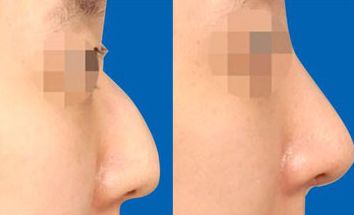 南京鼻綜合修復醫(yī)院哪家好？找準南京鼻部整形中心，為你解答！