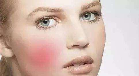 沈陽杏林醫(yī)生張瑩瑩治療雙眼皮修復效果如何？附真實網友高清修復前后對比圖