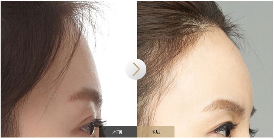 南寧點痣需求旺盛，哪家醫(yī)院是最受歡迎的？