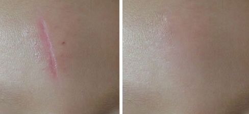 西安雙眼皮手術(shù)最佳推薦，哪家醫(yī)院技術(shù)好？