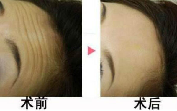 何晉龍的鼻型經(jīng)歷：立體挺拔，妥妥側(cè)顏殺！