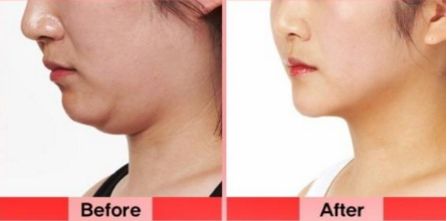 洛陽(yáng)雙眼皮修復(fù)哪家好？挑選專業(yè)技術(shù)實(shí)力強(qiáng)的醫(yī)療機(jī)構(gòu)