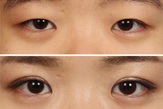 2023南京微創(chuàng)眼睛細紋手術(shù)醫(yī)生前10位排名(王軍成、江賀、郭鋒等都是強中強)