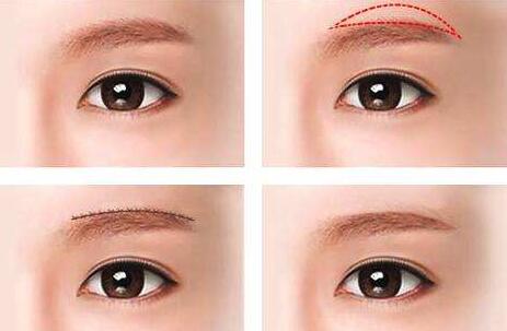 北京馮斌脂肪填充手術效果分析及相關費用查詢