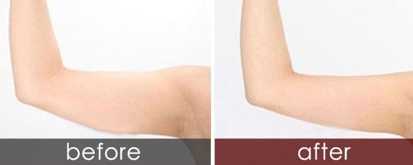 長春狐臭手術(shù)哪家醫(yī)院最專業(yè)？選擇哪家醫(yī)院治療狐臭效果好