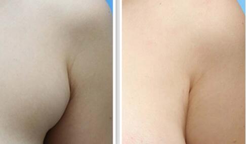 深圳北大何君君墊下巴案例分享，細節(jié)透露驚艷效果