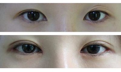 長沙哪家醫(yī)院專業(yè)去痘印效果好，讓你的肌膚恢復(fù)光滑無瑕